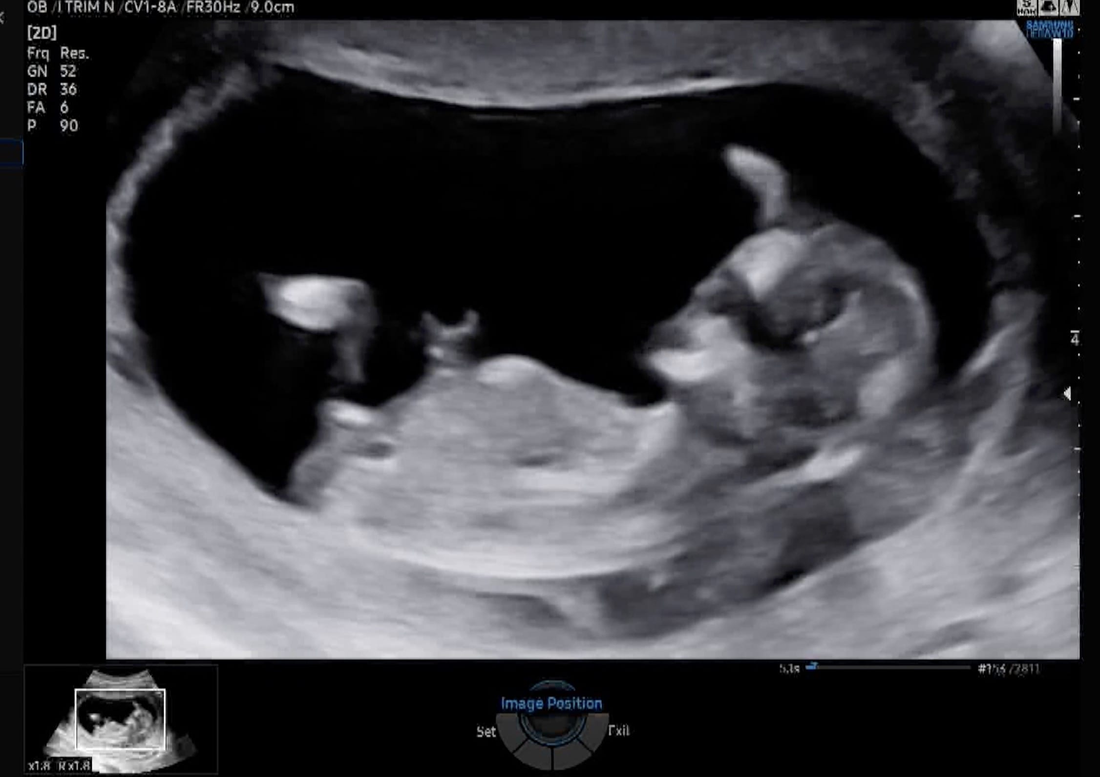 Photo placeholder: And then my second one. Longer-term.